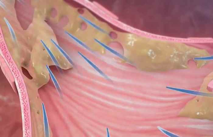 Sống khỏe 360 - Đông y điều trị viêm phế quản như thế nào? (12-09-2020)